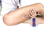 Venas-varices.webp