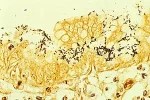 300px-Pylorigastritis.webp