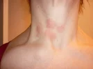 PSORIASIS.webp