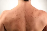 Queratosis-solares.webp Queratosis-solares.webp