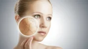 cuidar piel invierno acne.webp