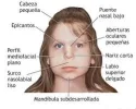 prader-willi.webp