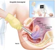 vaginalmente.webp