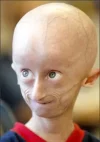 Progeria.webp