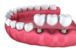 implantes-dentales.webp