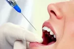 Dental-Anesthesia-Side-Effects_398x265.webp