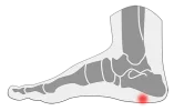 fascitis-plantar.webp